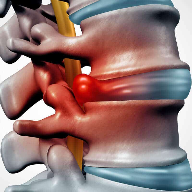 Intervertebral disc
