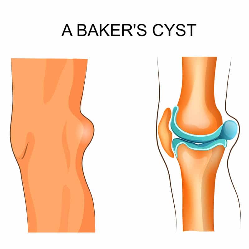 baker's cyst