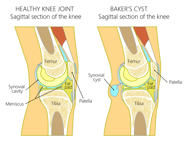 anatomy of the bakers cyst