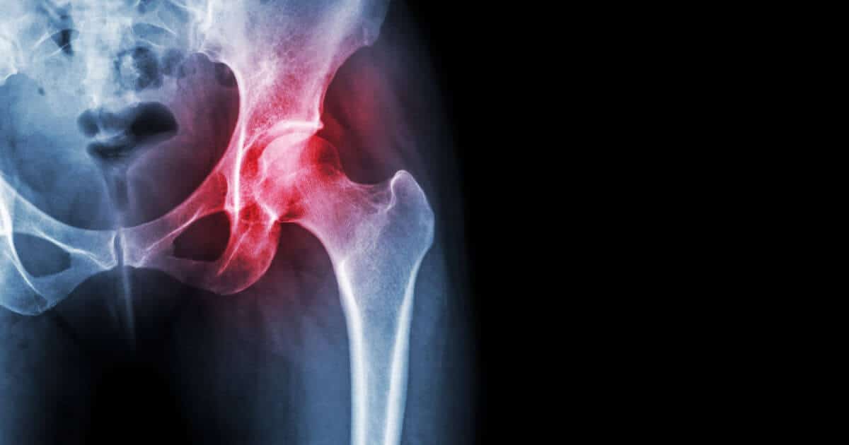X-ray of a hip bone.