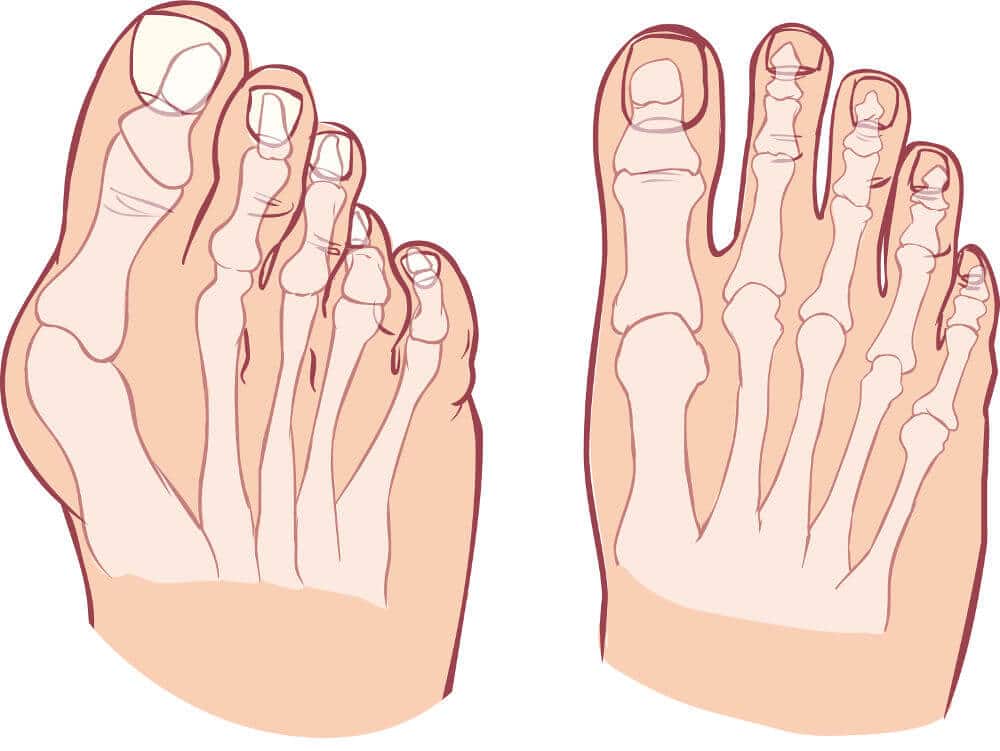 Graphical visualisation of the hallux valgus malposition of the bones in the foot.