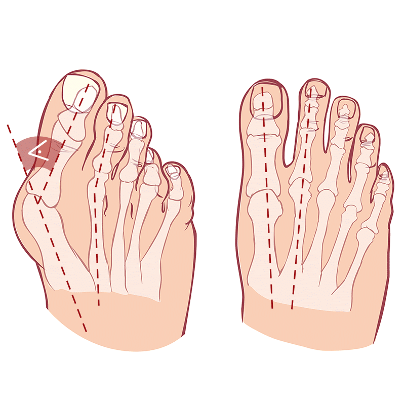 Illustration of the hallux valgus angle