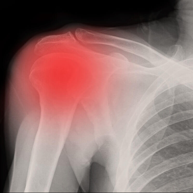 Illustration of a frozen shoulder pain
