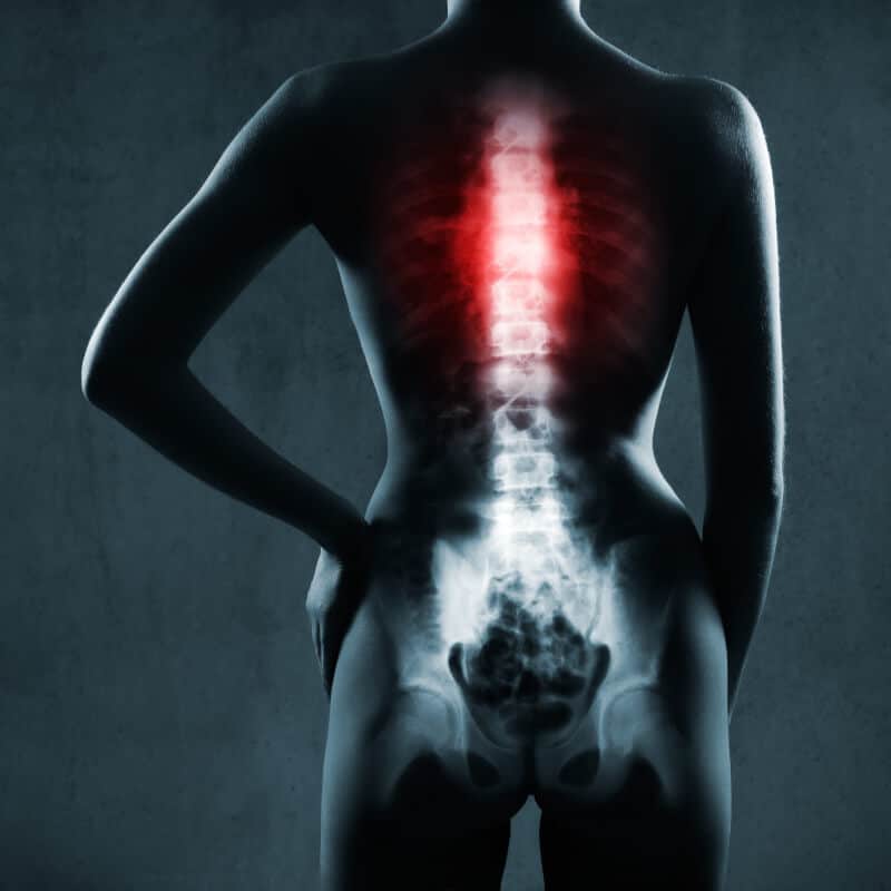 Illustration of an inflammed spine.