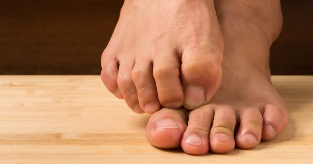 Hallux Rigidus Symptoms & Causes Liebscher & Bracht
