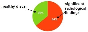 A pie diagram of the spondylosis prevalence.