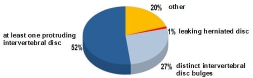 Pie diagram of spondylosis statistics.