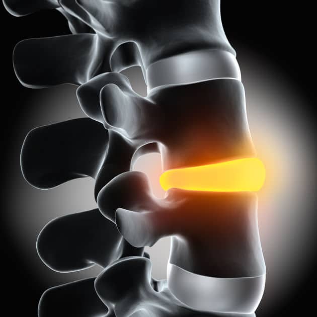 This is what a bulging disc looks like.