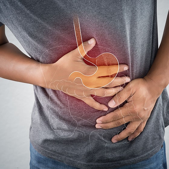 image of stomach producing too much acid; causing acid reflux or heartburn