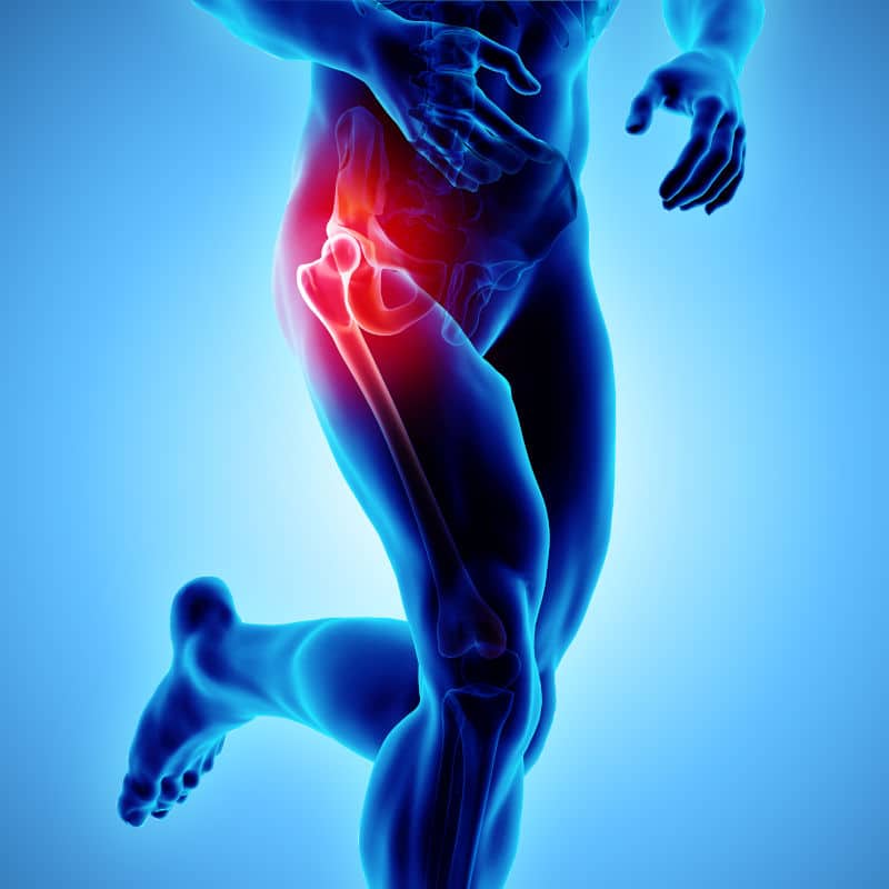 An image of hip osteoarthritis