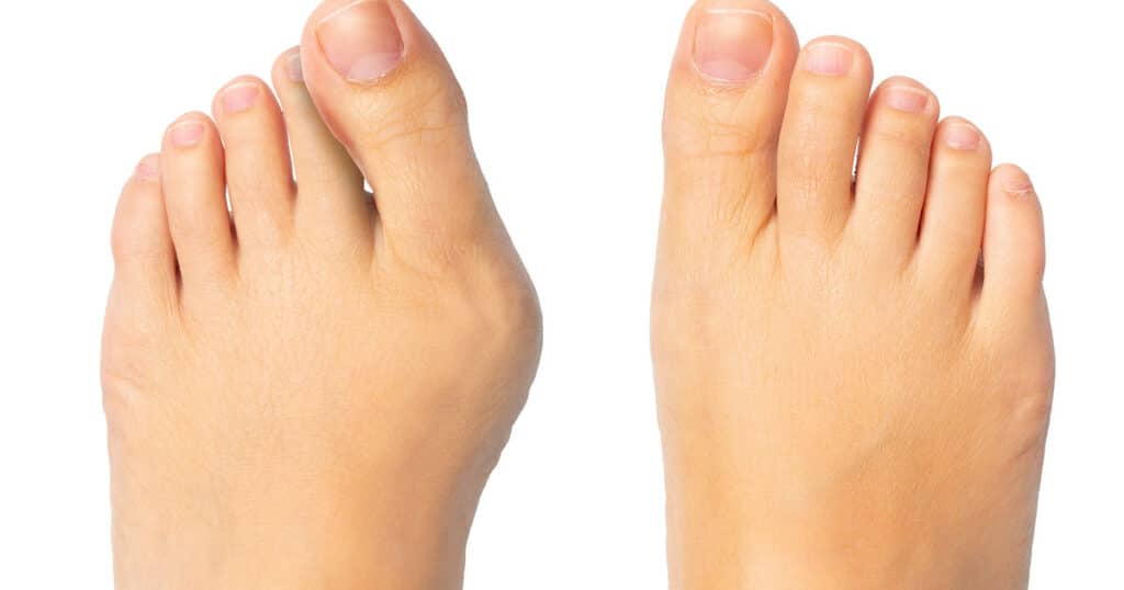 Closeup of two feet, the left one has a bunion.