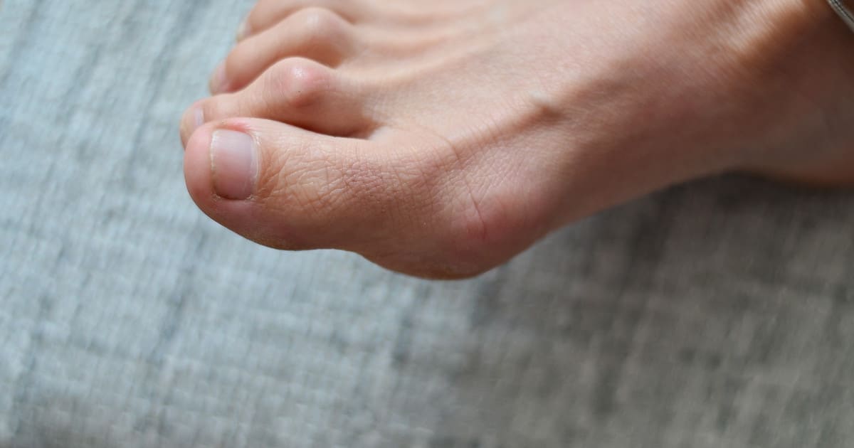 Closeup of a foot with hammer toe.