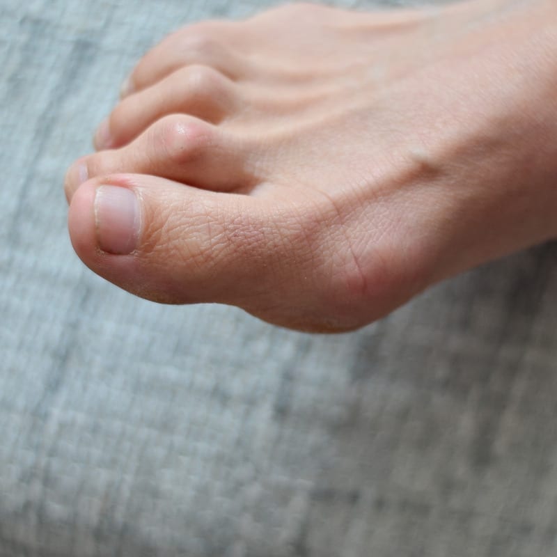 Closeup of a foot with hammer toe