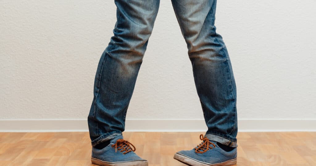 Closeup of a person with knock knees (genu valgum).