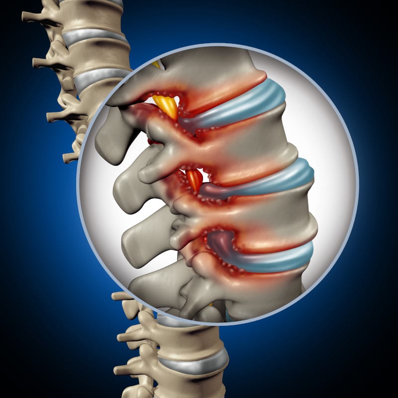 image of spinal stenosis