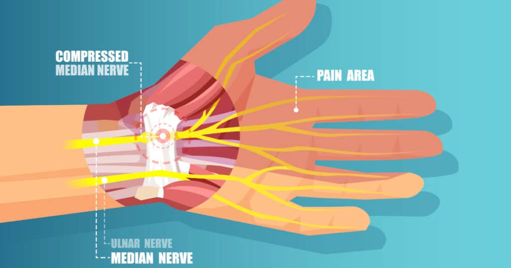 Diagram of hand with carpal tunnel.