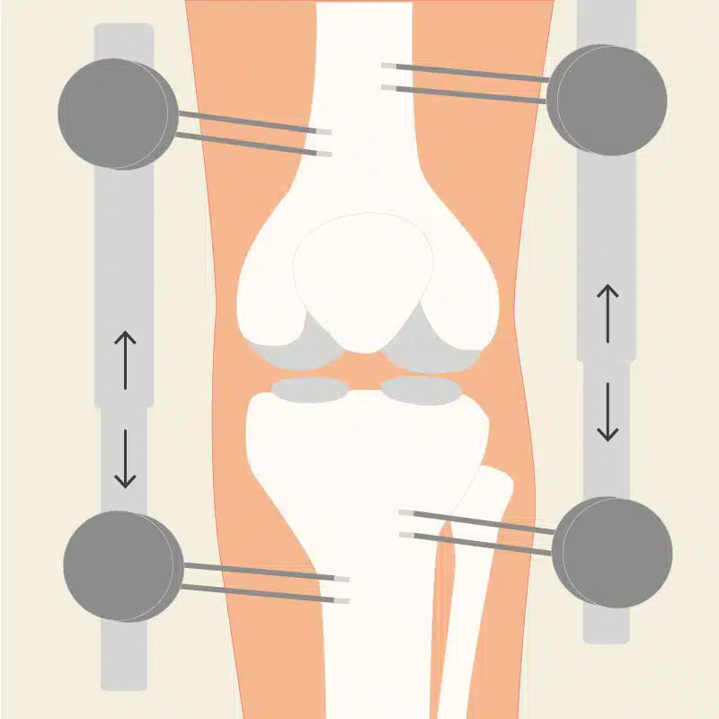 Graphic of a knee distraction
