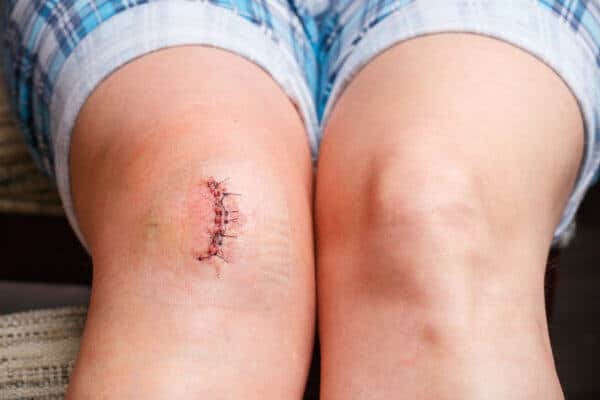 Person im Sitzen, Nahaufnahme der Knie. Das linke Knie hat eine große, frische Narbe.