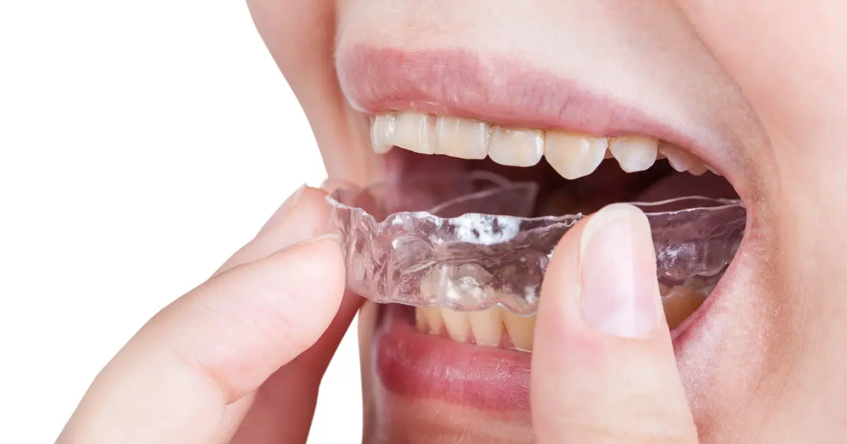 Frau setzt Aufbissschiene in ihren Mund