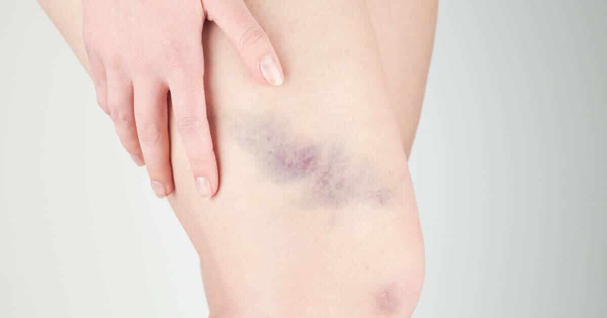 Thrombose erkennen, behandeln und vorbeugen | Liebscher & Bracht