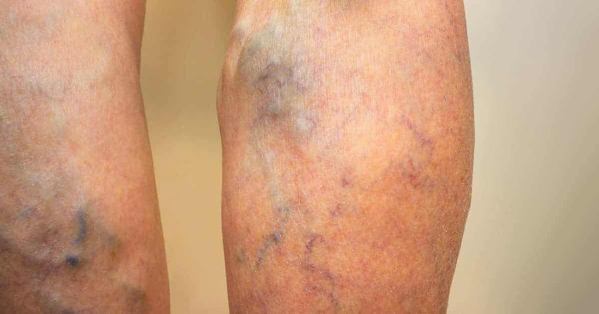 Thrombose erkennen, behandeln und vorbeugen Liebscher & Bracht