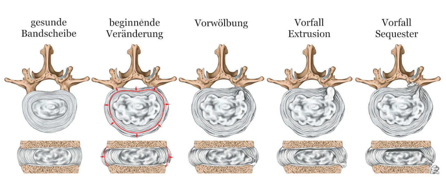 Bandscheibenvorfall der HWS Symptome, Ursachen und Übungen Liebscher