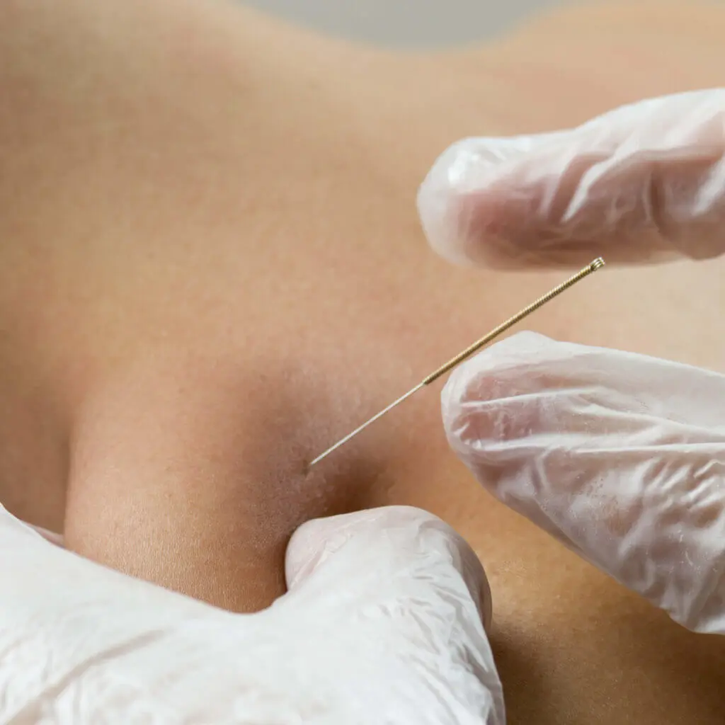 Ein Therapeut mit Hygienehandschuhen sticht eine Nadel in einen Triggerpunkt am Rücken