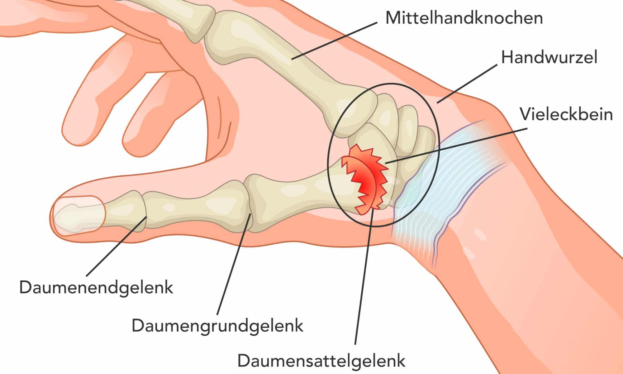 Bänderriss Daumen Wie Lange Krank www.liebscher-bracht.com