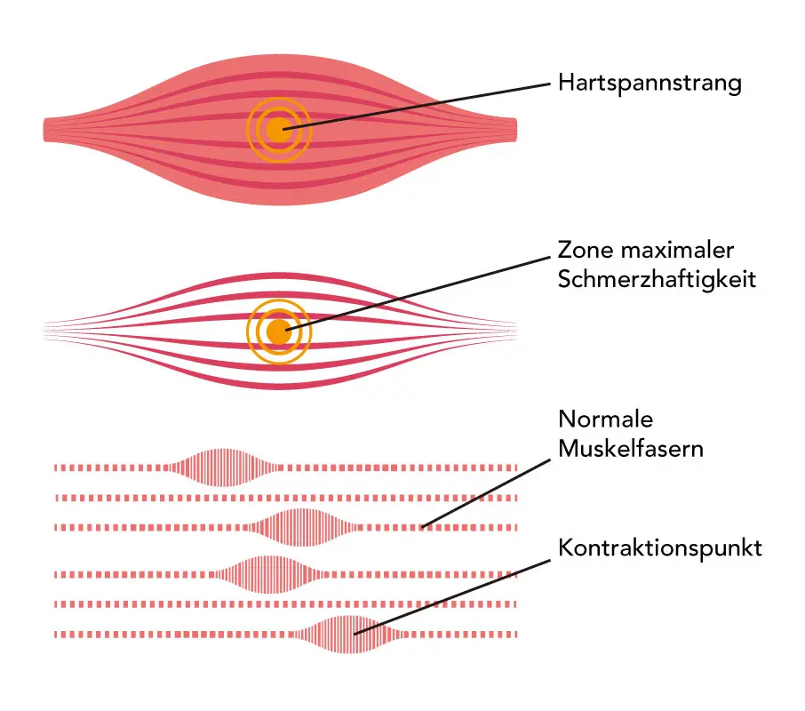 Taut Band, Hartspannstrang, Triggerpunkt