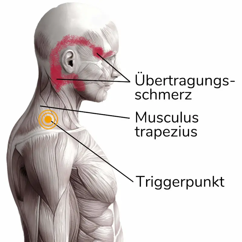 Schulterschmerzen werden durch einen Triggerpunkt im Trapezius ausgelöst
