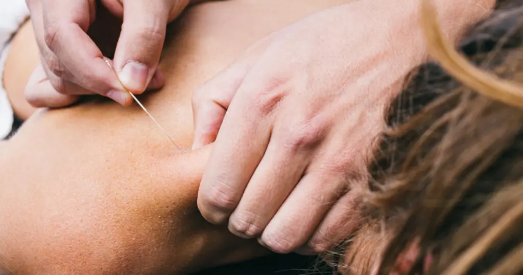 Ausführung von Dry Needling zur Behandlung von Triggerpunkten am Rücken einer Frau