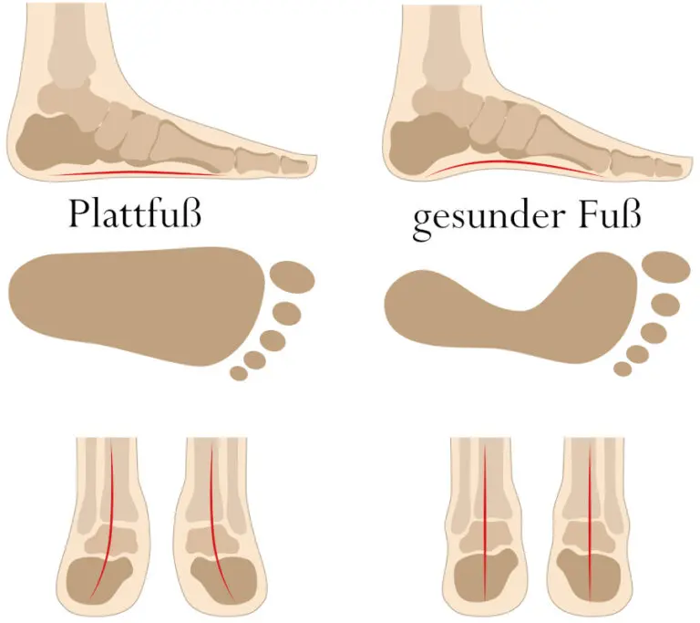 Plattfuß Hilfe bei Schmerzen durch eine aufliegende Fußsohle Liebscher & Bracht