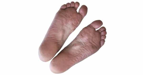 Morbus Dupuytren: Symptome, Ursachen & Übungen | Liebscher & Bracht