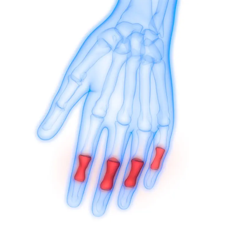 Arthrose im Finger Endlich Schluss mit den Schmerzen Liebscher & Bracht