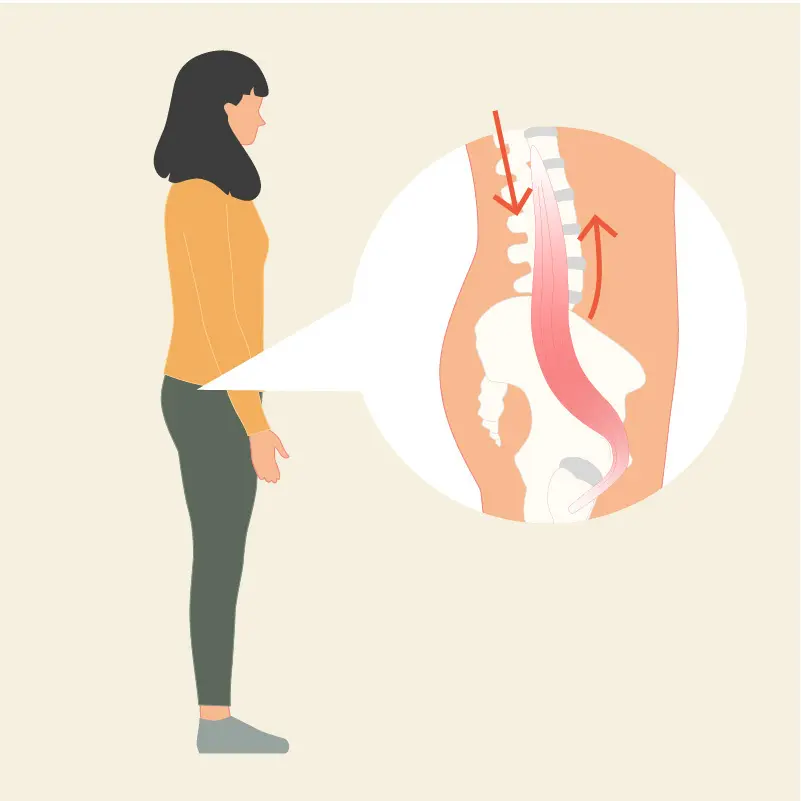 Die gezeichnete Grafik zeigt eine stehende Frau im ockerfarbenen Oberteil. In einer Vergrößerungslupe ist eine Zeichnung des Beckens von der Seite zu sehen. Ein Hüftbeuger ist eingezeichnet, Pfeile verdeutlichen die Zugspannungen, die von verkürzten Hüftbeugern ausgehen, sowie die Gegenspannung der Rückenstrecker