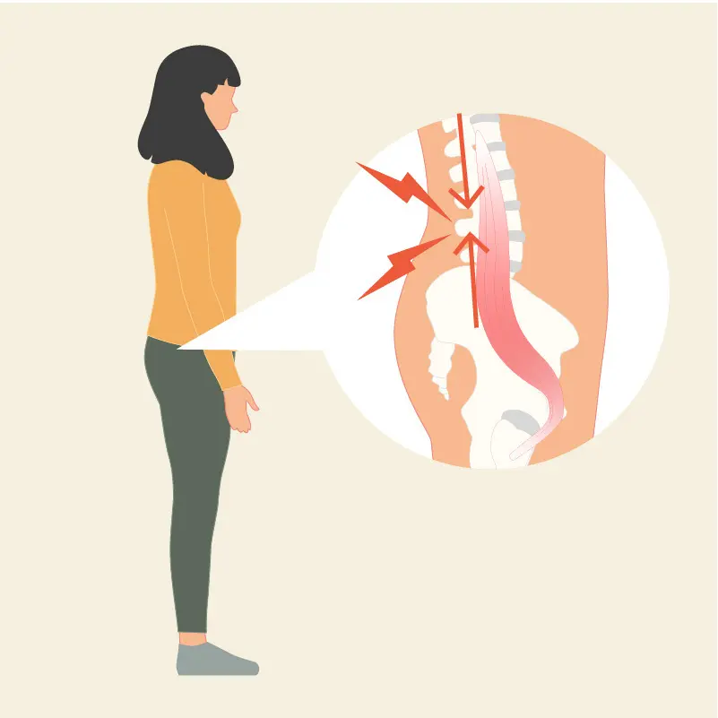 Die gezeichnete Grafik zeigt eine stehende Frau im ockerfarbenen Oberteil. In einer Vergrößerungslupe ist eine Zeichnung des Beckens von der Seite zu sehen. Ein Hüftbeuger ist eingezeichnet, Pfeile verdeutlichen den Schmerz, der durch Überspannungen der Hüftbeuger entsteht.