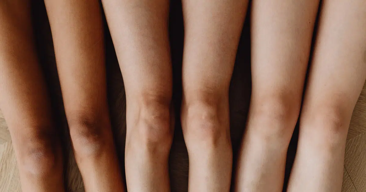 Foto von vier Beinpaaren nebeneinander. Die Knie bilden dabei die Bildmitte