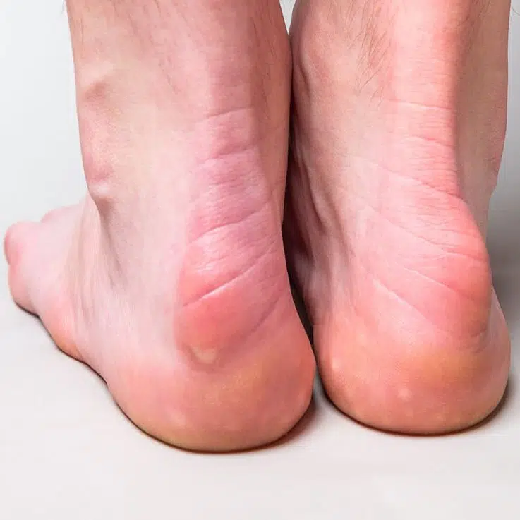 Zu sehen ist ein Paar Füße von hinten mit deutlich sichtbarem Überbein aufgrund einer Haglundferse.