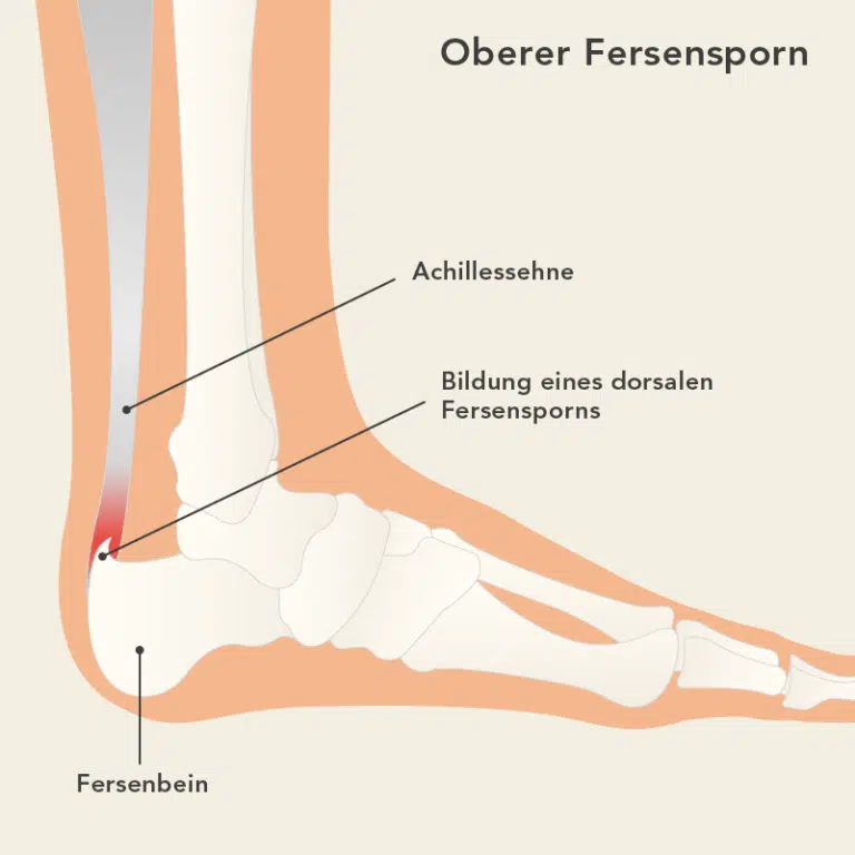 Tiefer Riss In Der Ferse Hausmittel Oberer Fersensporn: Ursachen, Symptome und Behandlung | Liebscher & Bracht
