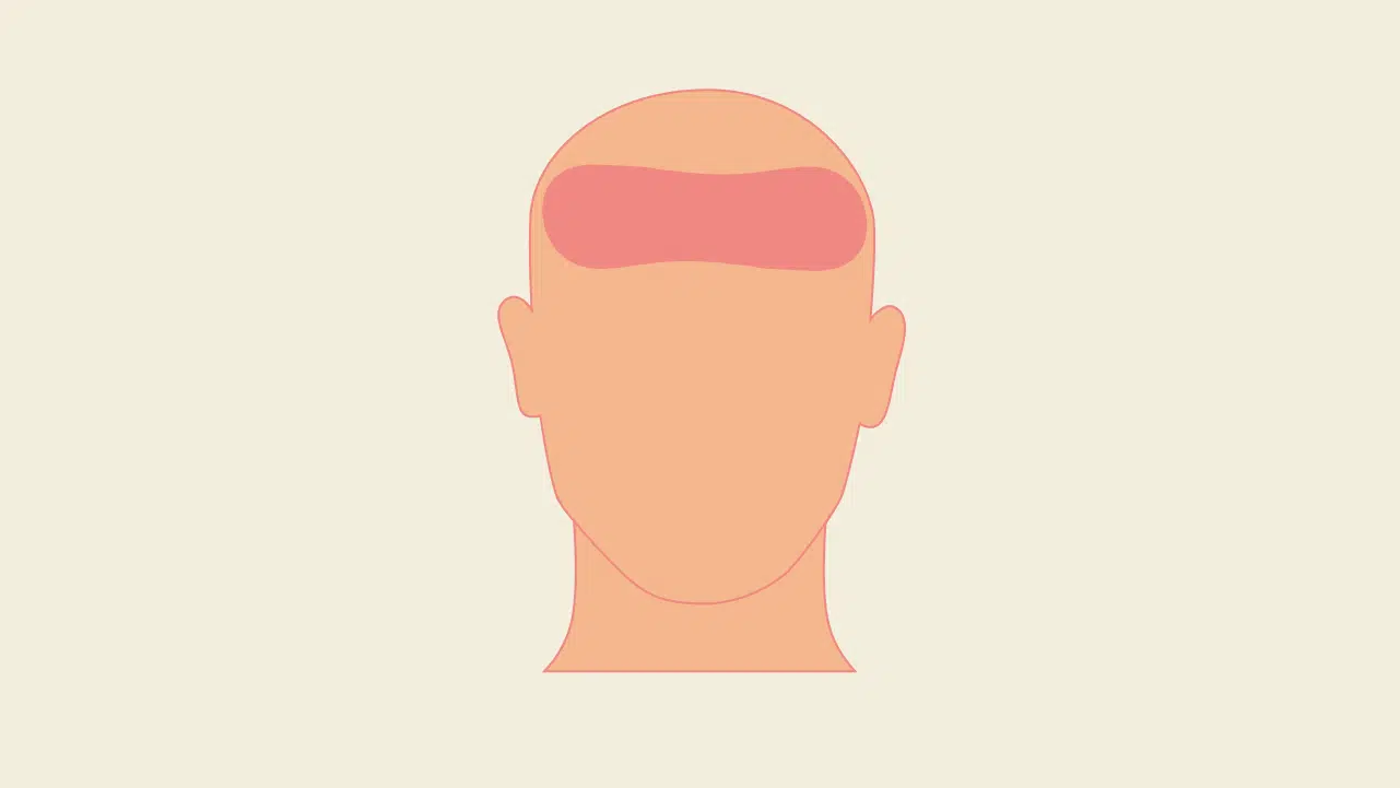 Grafische Darstellung eines Kopfes, auf dem die Stirn markiert ist, um den Kopfschmerz-Bereich zu visualisieren.