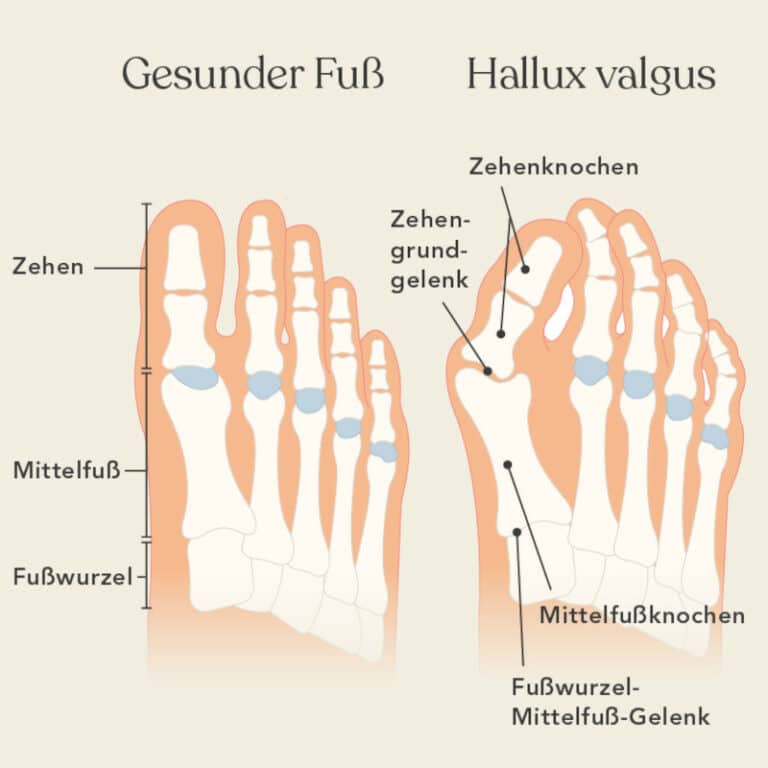 Hallux valgus Ursache – so entsteht der Ballenzeh | Liebscher & Bracht