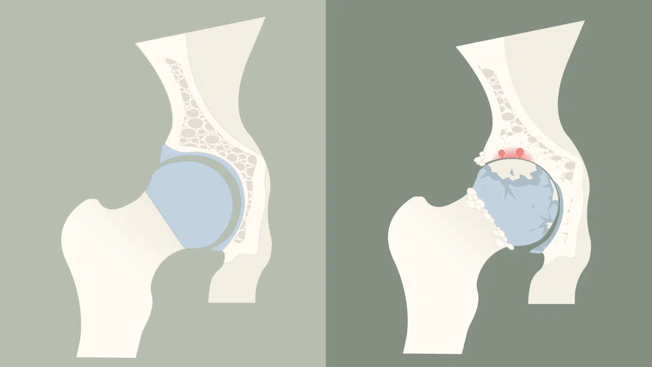 Arthrose: Symptome, Verlauf, Behandlung