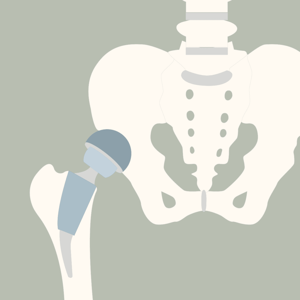 Grafische Darstellung einer Hüft-Prothese im Becken.