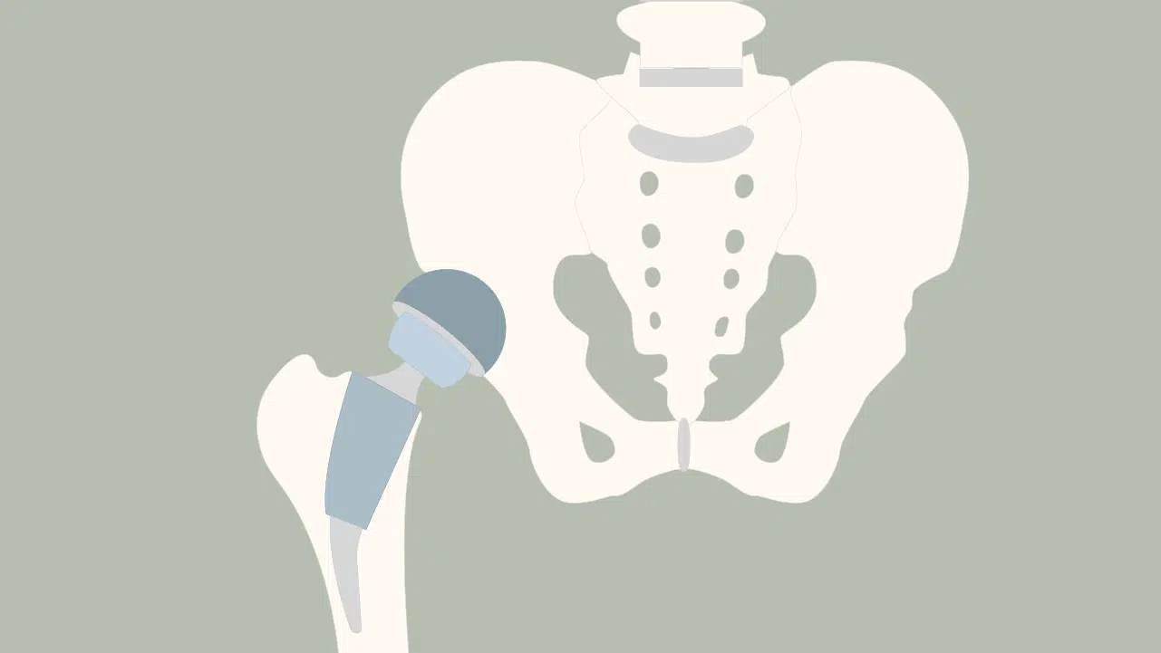 Grafische Darstellung einer Hüft-Prothese im Becken.