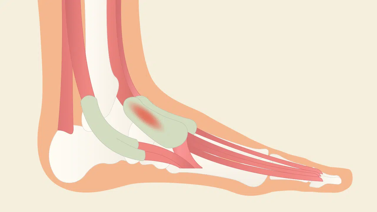 Illustration eines Fußes mit Sehnenscheiden auf dem Fußrücken und am Außenknöchel.