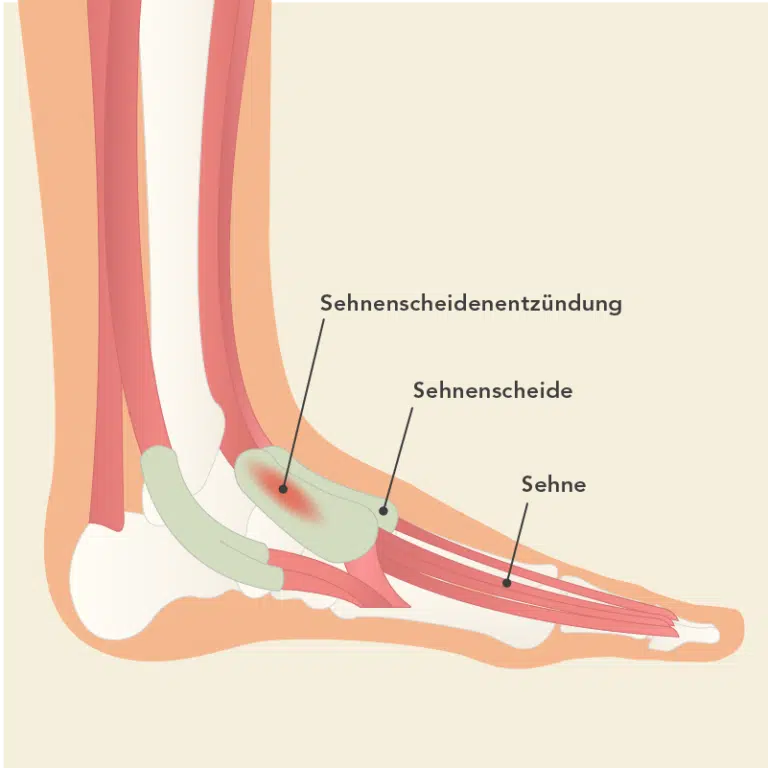 Sehnenscheidenentzündung Fuß Liebscher & Bracht