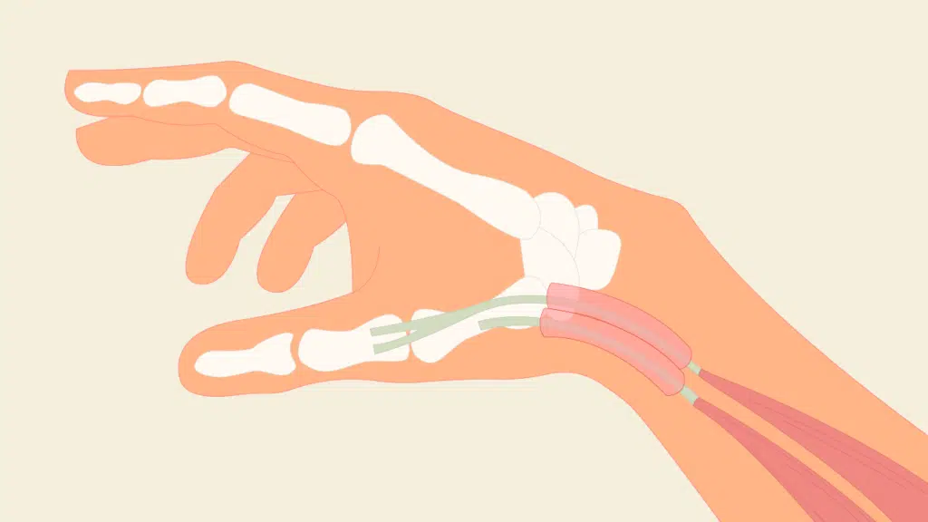 Illustration einer Hand mit Sehnenscheidenentzündung am Handgelenk. Die Sehnen und die Sehnenscheiden sind rötlich hervorgehoben.