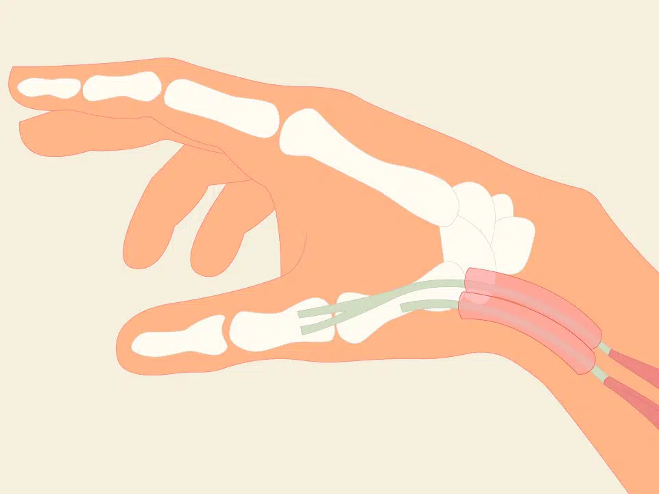 Illustration einer Hand mit Sehnenscheidenentzündung am Handgelenk. Die Sehnen und die Sehnenscheiden sind rötlich hervorgehoben.