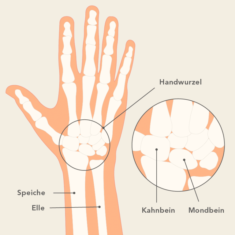 Arthrose im Handgelenk: Entstehung und Behandlung | Liebscher & Bracht