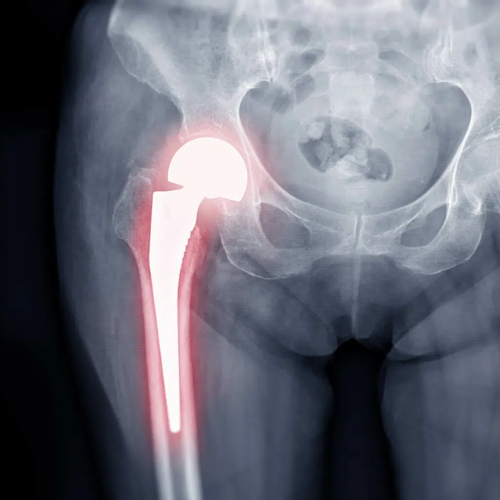 Ein röntgenologisches Bild einer Hüfte mit Prothese. Diese ist rot eingefärbt.